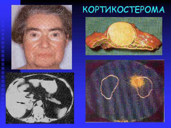 КОРТИКОСТЕРОМА 