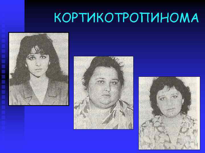 КОРТИКОТРОПИНОМА 
