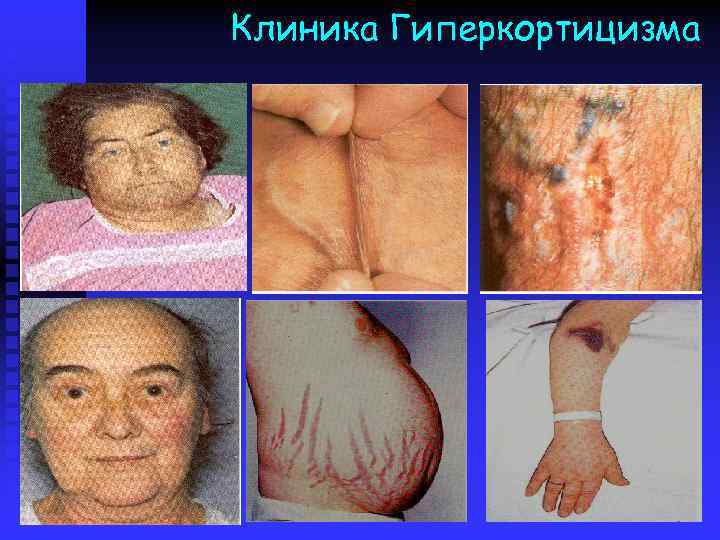 Клиника Гиперкортицизма 