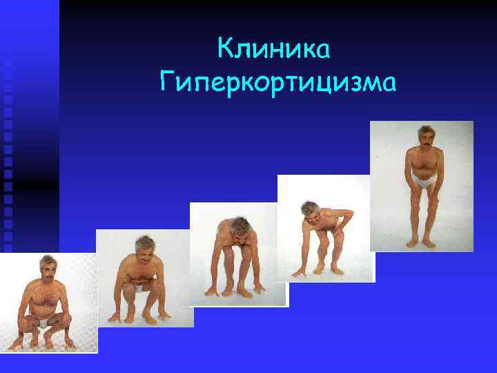 Клиника Гиперкортицизма 