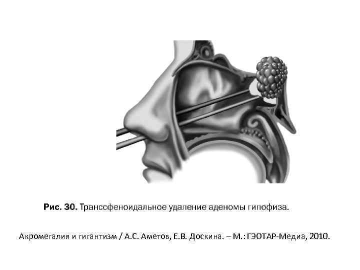 Акромегалия и гигантизм / А. С. Аметов, Е. В. Доскина. – М. : ГЭОТАР-Медиа,