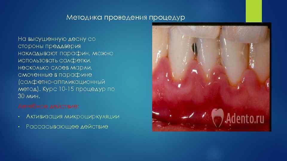 Методика проведения процедур На высушенную десну со стороны преддверия накладывают парафин, можно использовать салфетки,