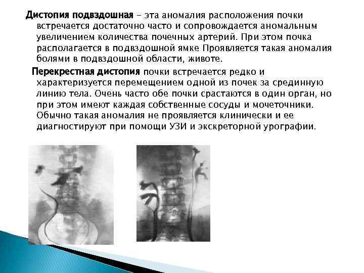 Дистопия почки. Поясничная дистопия почки на УЗИ. Гетеролатеральная дистопия почки. Тазовая и подвздошная дистопия почки.