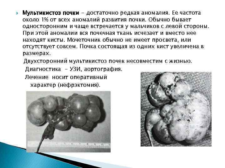  Мультикистоз почки - достаточно редкая аномалия. Ее частота около 1% от всех аномалий