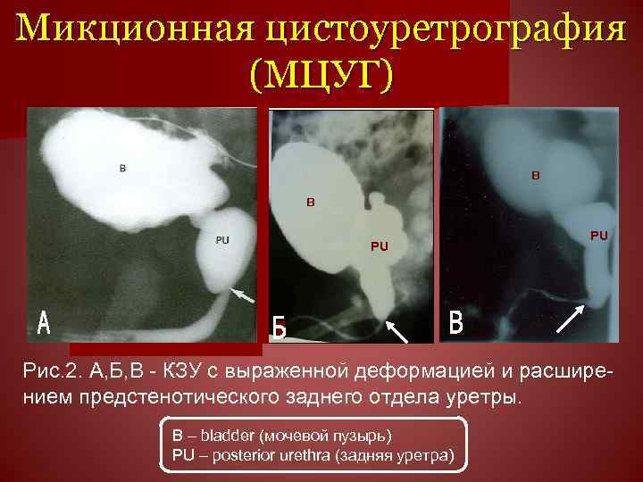 Микционная цистоуретрография (МЦУГ) в в PU PU Рис. 2. А, Б, В - КЗУ
