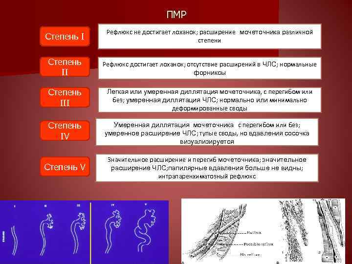 ПМР Степень I Рефлюкс не достигает лоханок; расширение мочеточника различной степени Степень II Рефлюкс