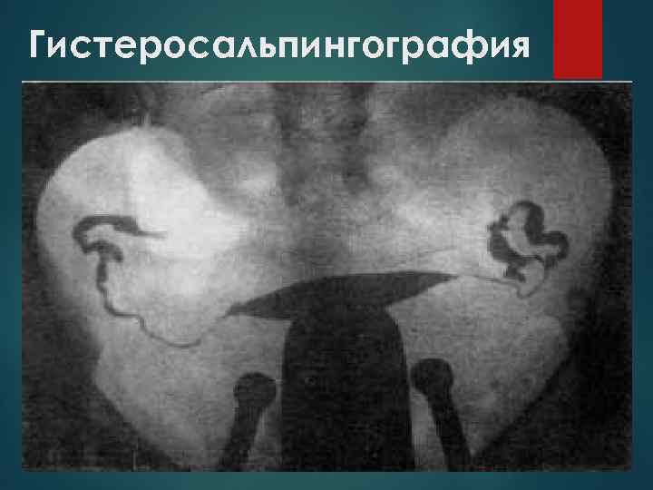 Гистеросальпингография 