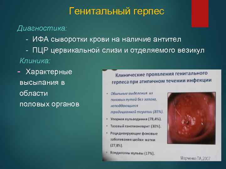 Генитальный герпес Диагностика: - ИФА сыворотки крови на наличие антител - ПЦР цервикальной слизи