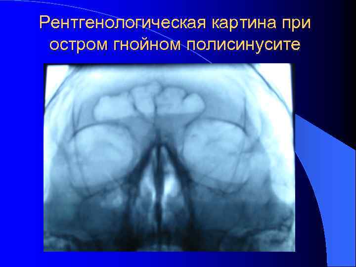 Рентгенологическая картина при остром гнойном полисинусите 