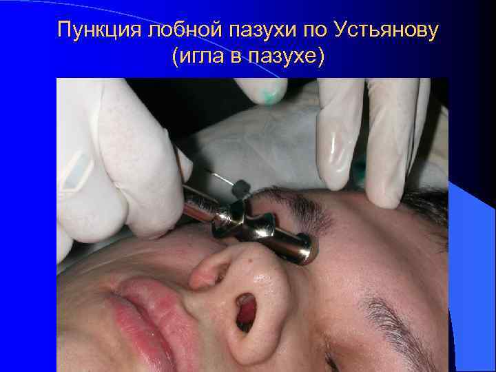Пункция лобной пазухи по Устьянову (игла в пазухе) 