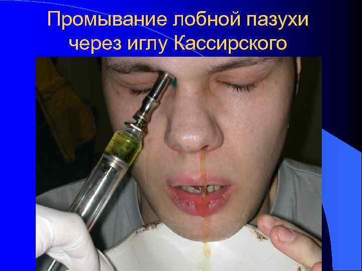 Промывание лобной пазухи через иглу Кассирского 