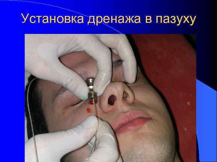 Установка дренажа в пазуху 