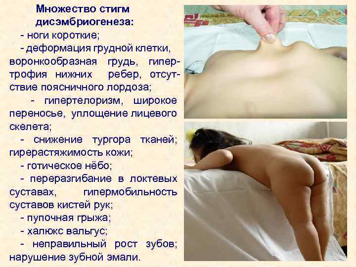  Множество стигм дисэмбриогенеза: - ноги короткие; - деформация грудной клетки, воронкообразная грудь, гипертрофия