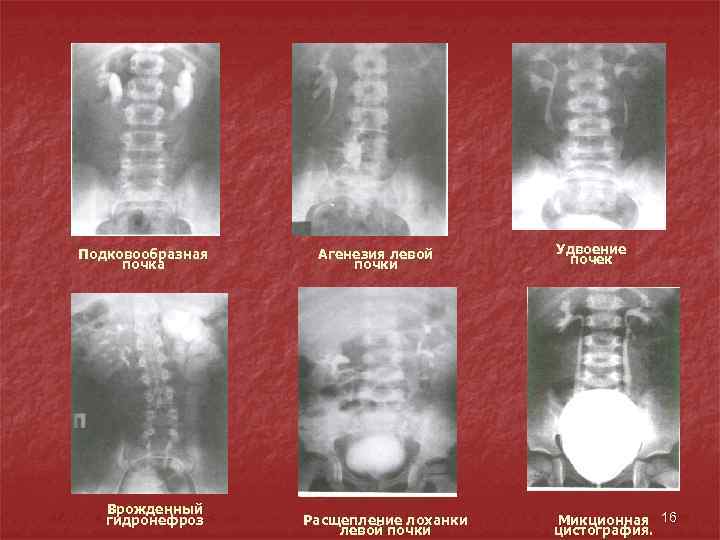 Подковообразная почка Врожденный гидронефроз Агенезия левой почки Расщепление лоханки левой почки Удвоение почек Микционная