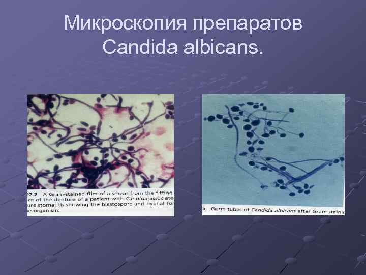 Микроскопия препаратов Candida albicans. 