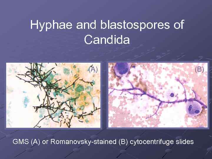 Hyphae and blastospores of Candida (A) GMS (A) or Romanovsky-stained (B) cytocentrifuge slides (B)