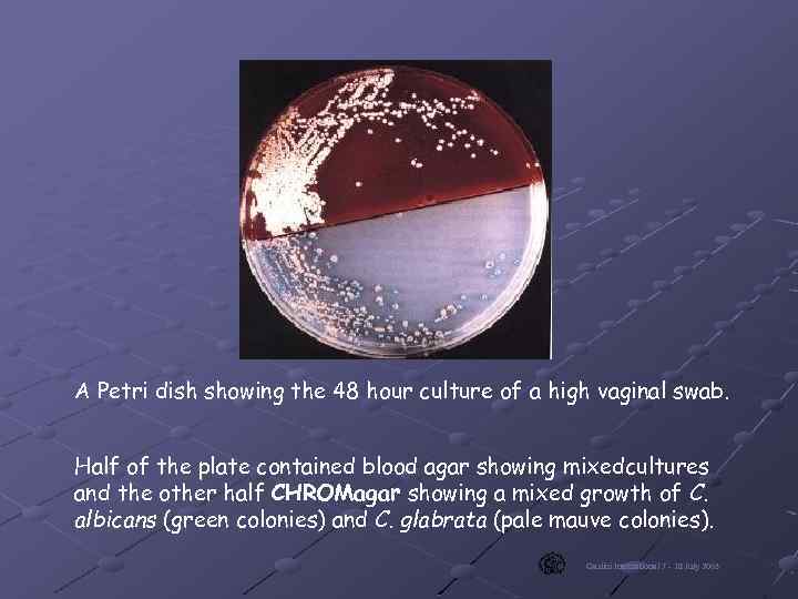 A Petri dish showing the 48 hour culture of a high vaginal swab. Half