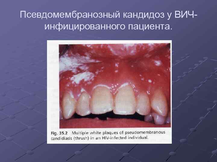 Псевдомембранозный кандидоз у ВИЧинфицированного пациента. 