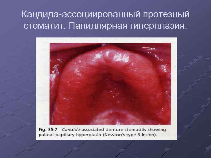 Кандида-ассоциированный протезный стоматит. Папиллярная гиперплазия. 