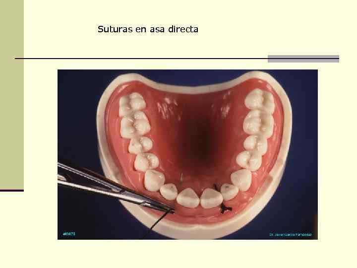 Suturas en asa directa 