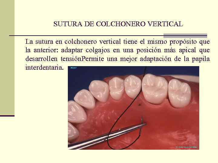 SUTURA DE COLCHONERO VERTICAL La sutura en colchonero vertical tiene el mismo propósito que