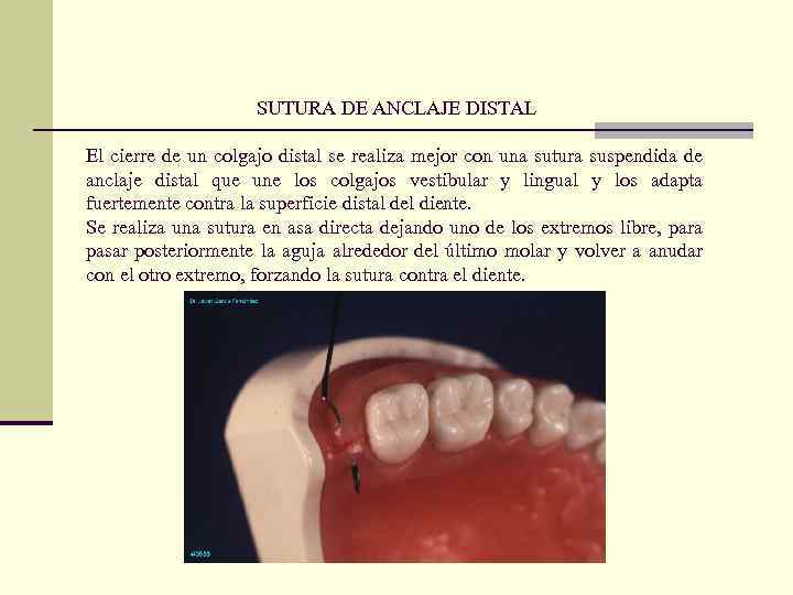 SUTURA DE ANCLAJE DISTAL El cierre de un colgajo distal se realiza mejor con