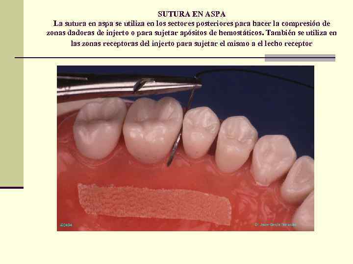 SUTURA EN ASPA La sutura en aspa se utiliza en los sectores posteriores para