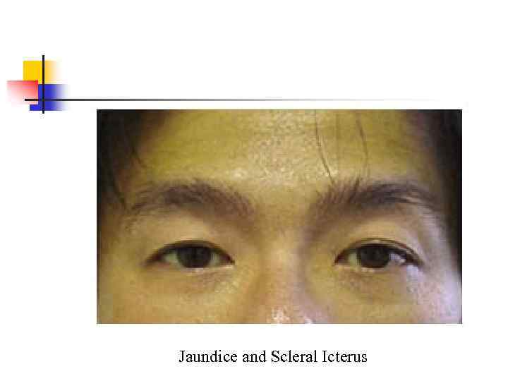 Jaundice and Scleral Icterus 