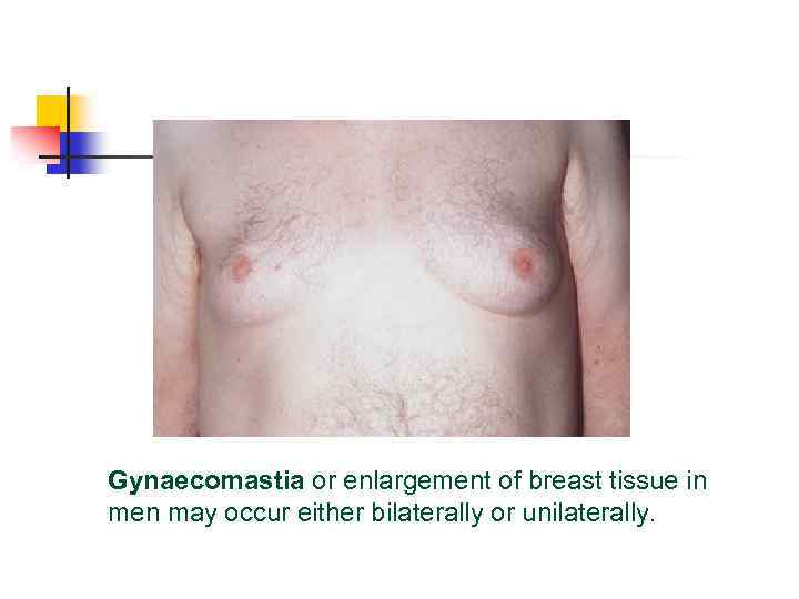 Gynaecomastia or enlargement of breast tissue in men may occur either bilaterally or unilaterally.