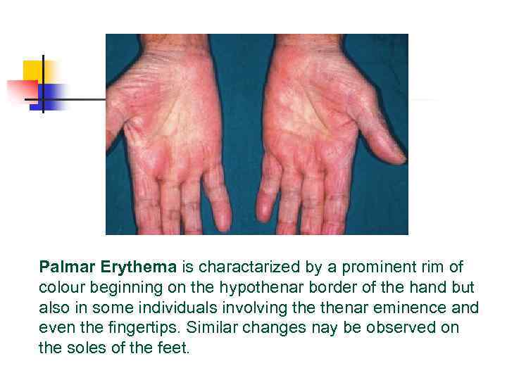 Palmar Erythema is charactarized by a prominent rim of colour beginning on the hypothenar