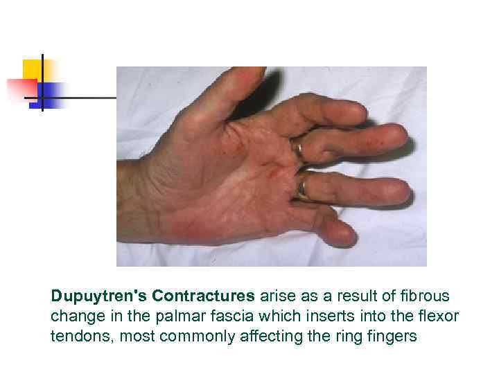 Dupuytren's Contractures arise as a result of fibrous change in the palmar fascia which