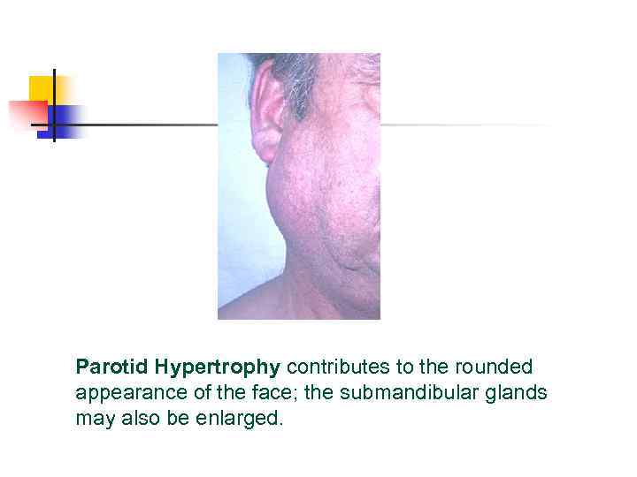 Parotid Hypertrophy contributes to the rounded appearance of the face; the submandibular glands may