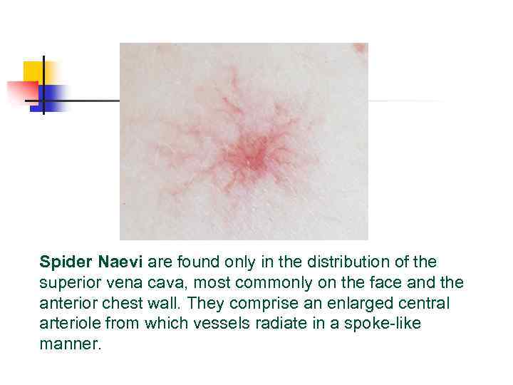 Spider Naevi are found only in the distribution of the superior vena cava, most