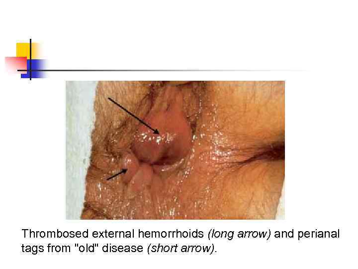 Thrombosed external hemorrhoids (long arrow) and perianal tags from 