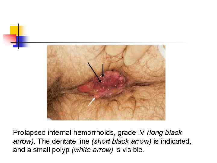 Prolapsed internal hemorrhoids, grade IV (long black arrow). The dentate line (short black arrow)