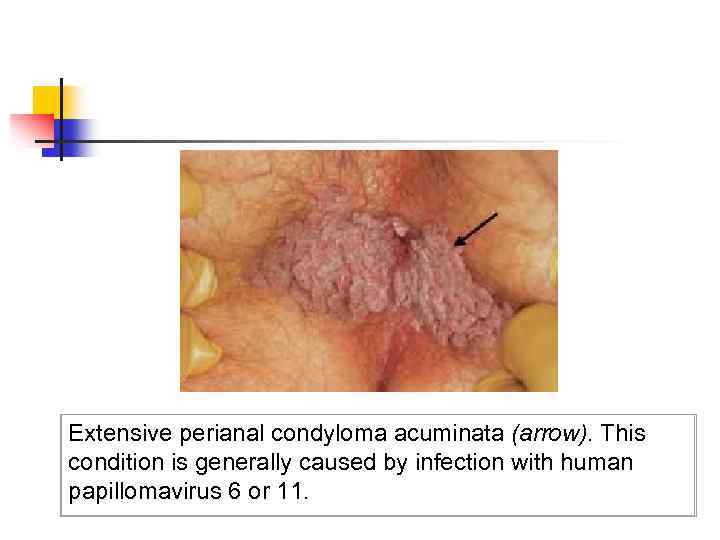 Extensive perianal condyloma acuminata (arrow). This condition is generally caused by infection with human