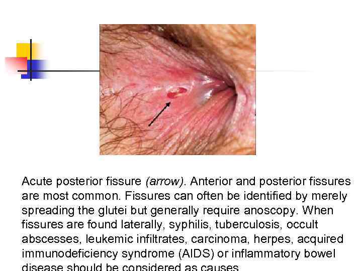 Acute posterior fissure (arrow). Anterior and posterior fissures are most common. Fissures can often