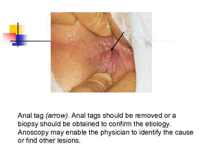 Anal tag (arrow). Anal tags should be removed or a biopsy should be obtained