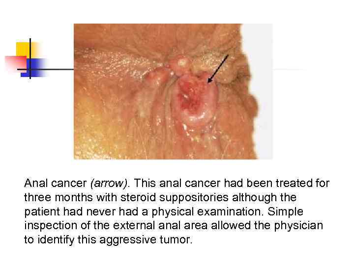 Anal cancer (arrow). This anal cancer had been treated for three months with steroid