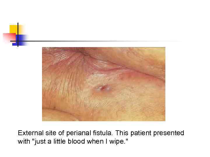 External site of perianal fistula. This patient presented with 