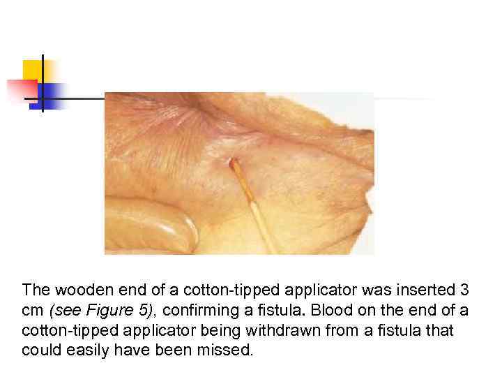 The wooden end of a cotton-tipped applicator was inserted 3 cm (see Figure 5),