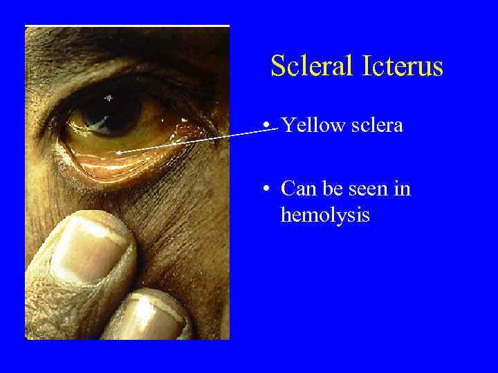 Scleral Icterus • Yellow sclera • Can be seen in hemolysis 