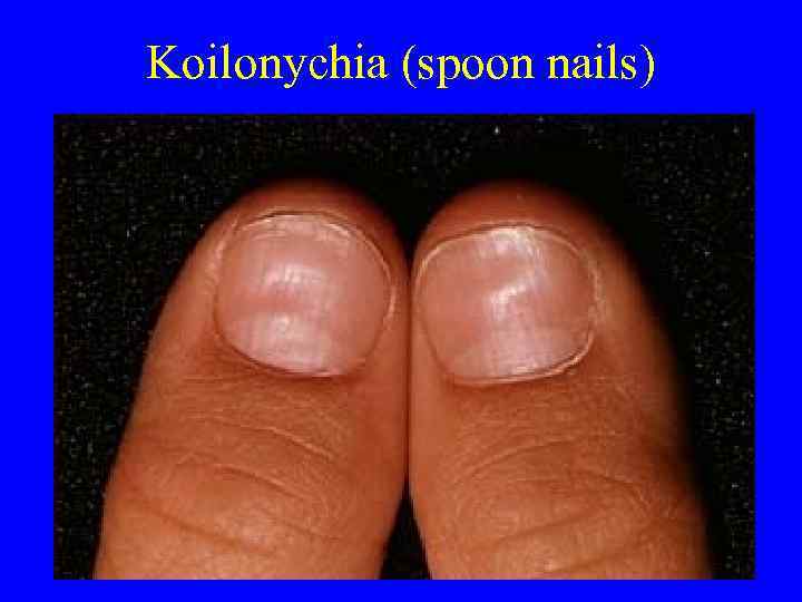 Koilonychia (spoon nails) 