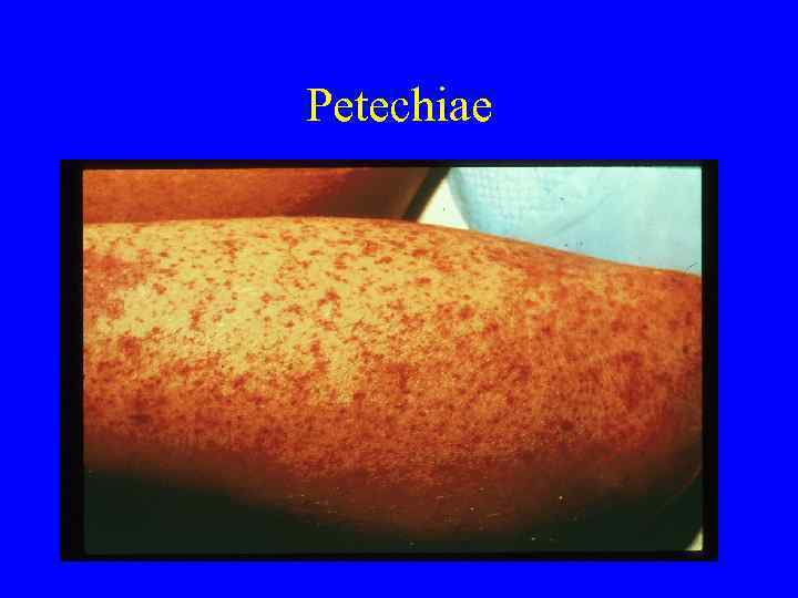 Petechiae 