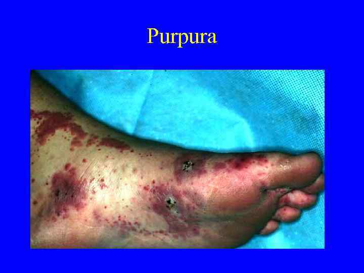 Purpura 