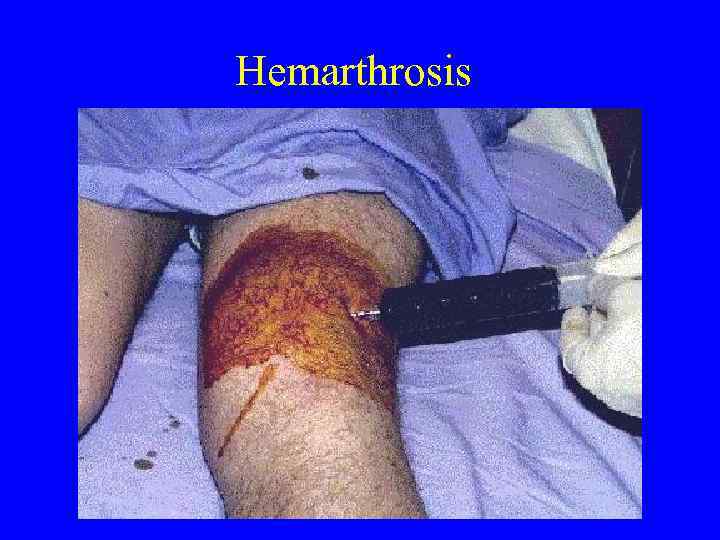 Hemarthrosis 