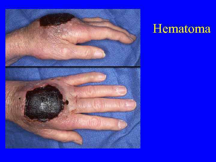 Hematoma 