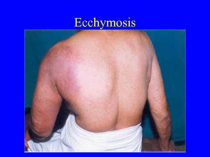 Ecchymosis 