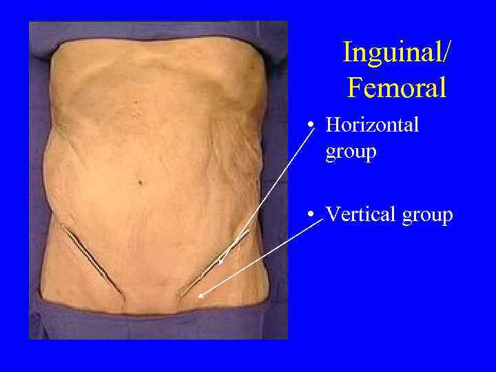 Inguinal/ Femoral • Horizontal group • Vertical group 