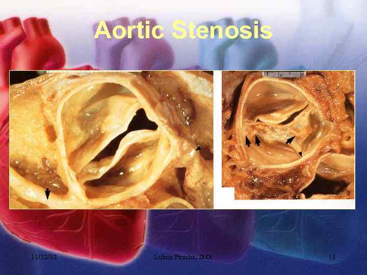 Aortic Stenosis 11/12/02 Lubna Piracha, D. O. 11 